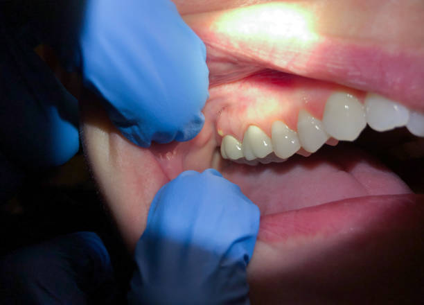 Best Emergency Dental Extractions in Stone Mountain, GA